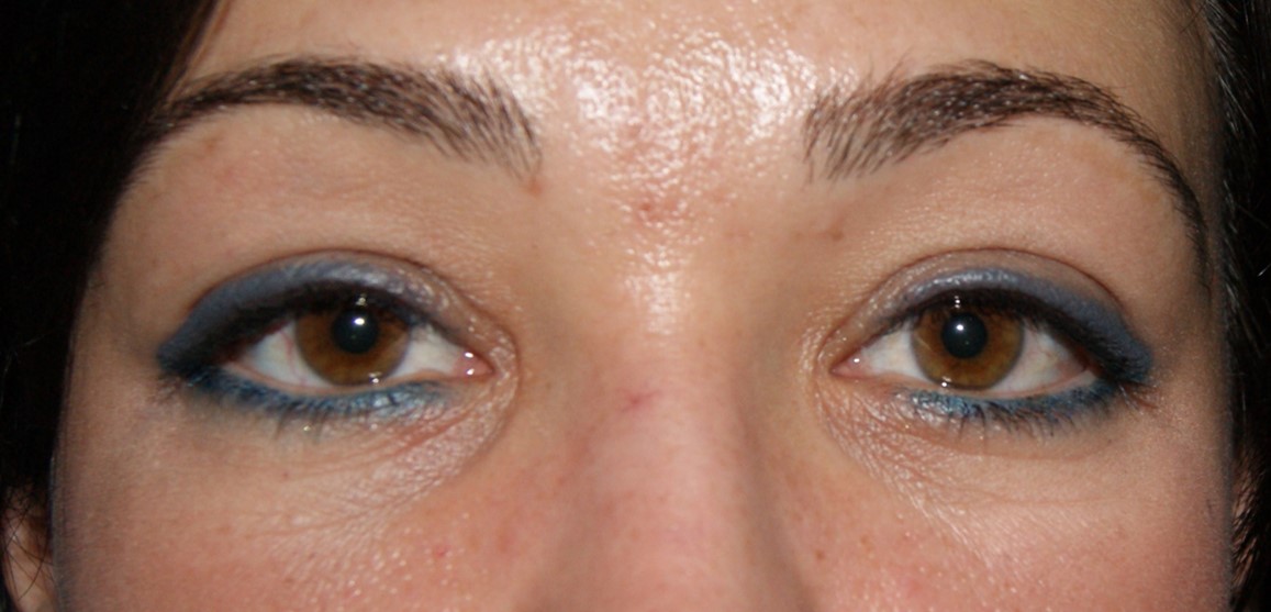 Blépharoplastie inférieure cas 2 apres