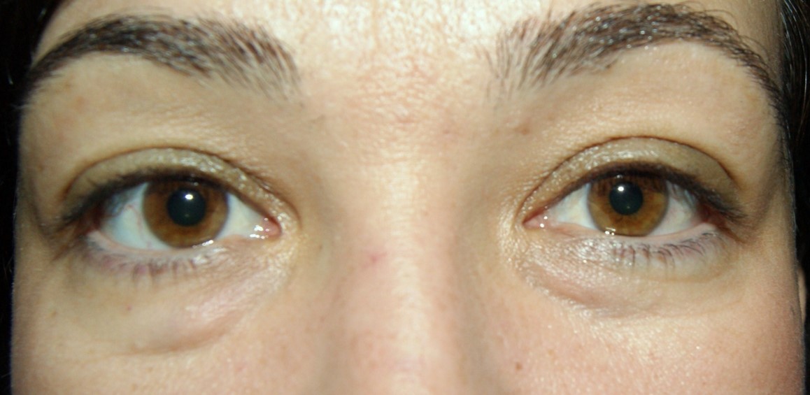 Blépharoplastie inférieure cas 2 avant