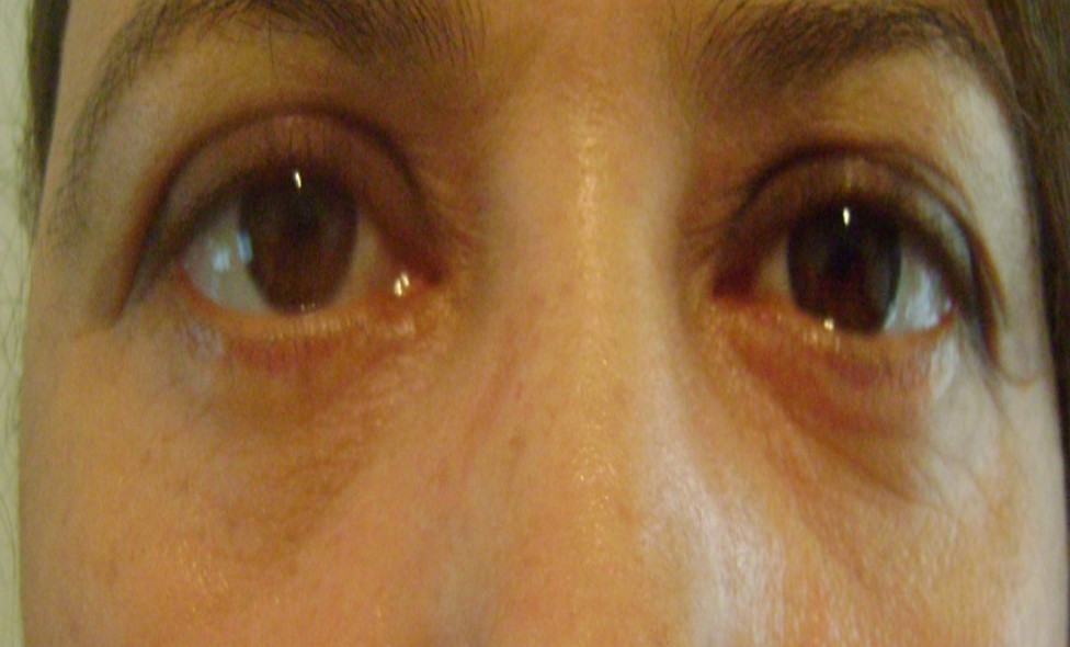 Blépharoplastie inférieure cas 3 apres