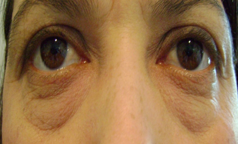 Blépharoplastie inférieure cas 3 avant