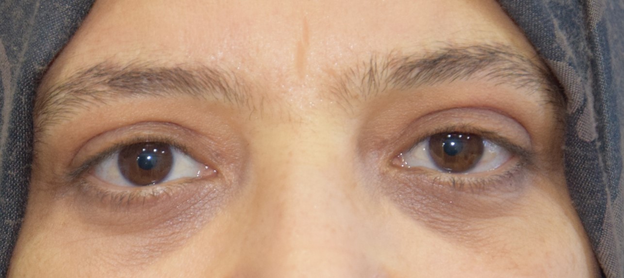 blépharoplastie supérieure cas 2 apres