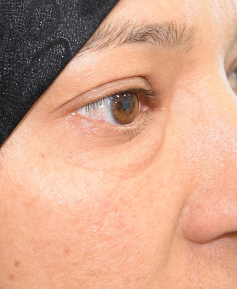 Blépharoplastie inférieure cas 1 avant